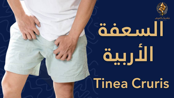 ما السعفة الاربية؟ وما أسبابها؟