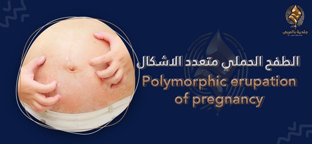 ما الذي يجب عليك معرفته عن الطفح الحملي متعدد الأشكال؟