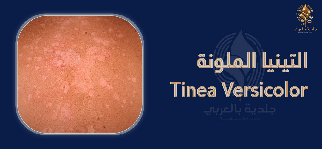 ما علاج التينيا الملونة؟ وما أسباب ظهورها على الجلد؟