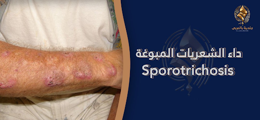 داء الشعريات المبوّغة (Sporotrichosis) تعرف على الأسباب والأعراض وطرق العلاج