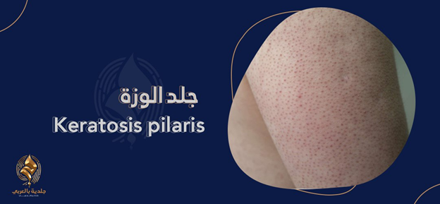 تعرف إلى أسباب ظهور جلد الوزة وطرق علاجه