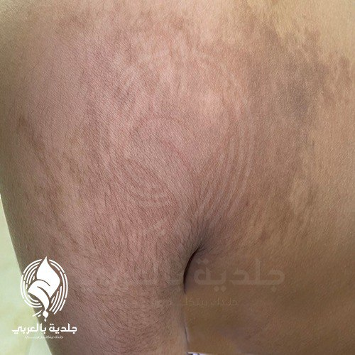 وحمة بيكر