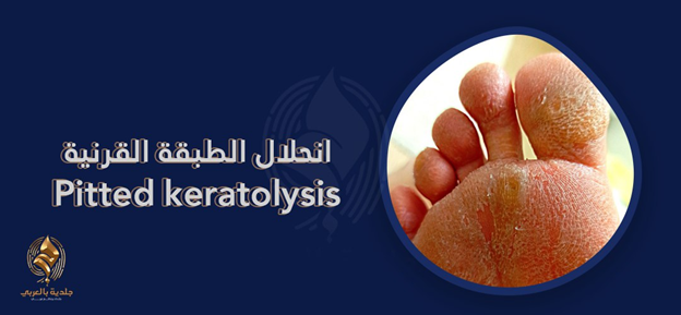 9 نصائح للوقاية من انحلال الطبقة القرنية الموهد (pitted keratolysis)