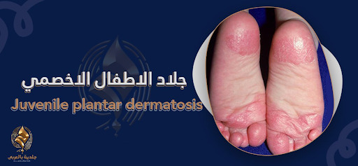 كل ما تحتاج معرفته عن جلاد الاطفال الأخمصي juvenile plantar dermatosis