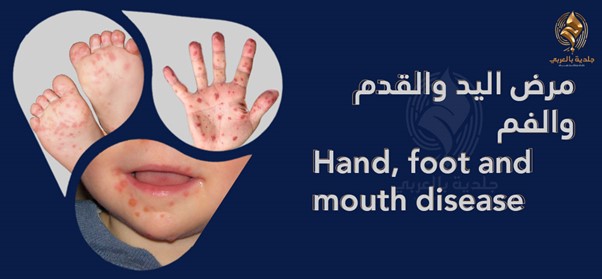 متلازمة الفم واليد والقدم | ما أسبابها وأعراضها وهل هي معدية؟