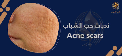 وداعًا ندبات حب الشباب Acne scars| الدليل الشامل للعلاج والوقاية