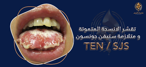 تقشر الأنسجة المتموتة البشروية التسممي (Toxic epidermal necrolysis)