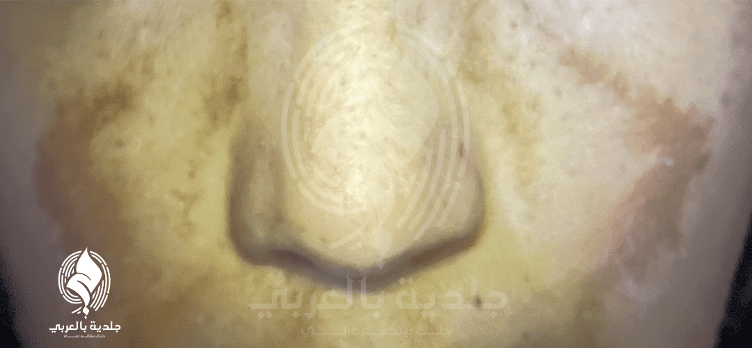 تشخيص الكلف