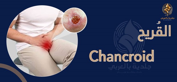chancroid مرض القرحة اللينة، أسبابه وعلاجه وكيفية الوقاية منه