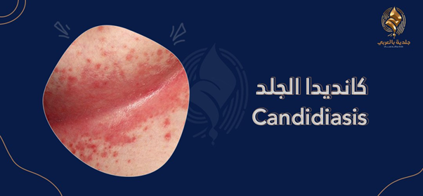 ما كانديدا الجلد؟ وما علاجها؟