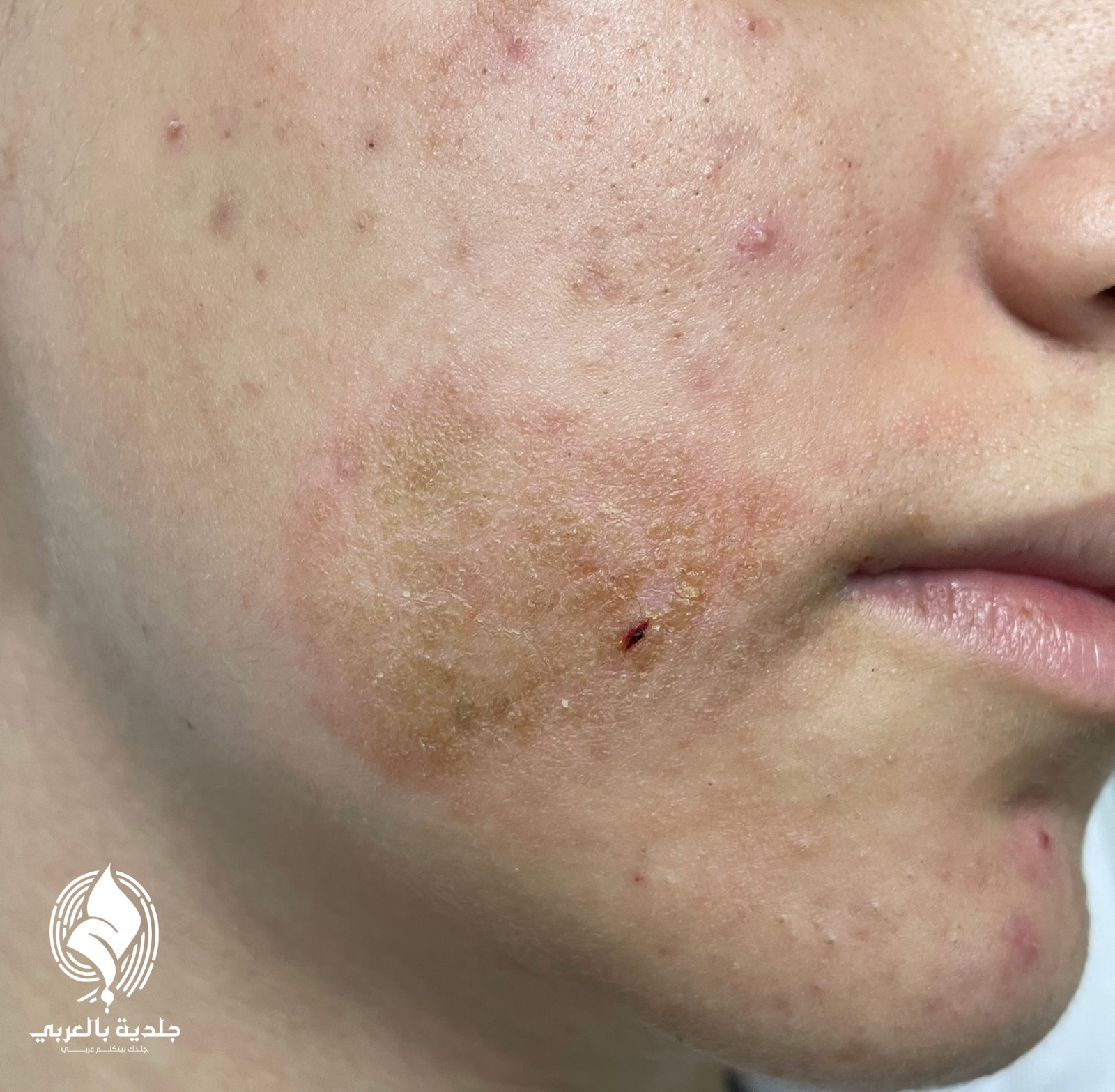 الاكزيما بالصور