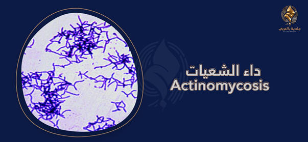 أعراض إذا وجدتها .. احذر داء الشعيات actinomycosis!