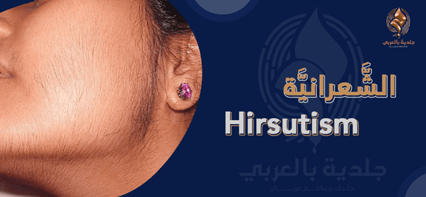علاج الشعرانية Hirsutism سعي للجمال أم علاج لأعراض مرضية