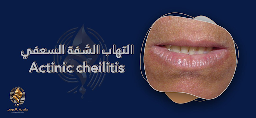 التهاب الشفة السعفي (Actinic Cheilitis) تعرَّف الأسباب والأعراض وطُرق العلاج