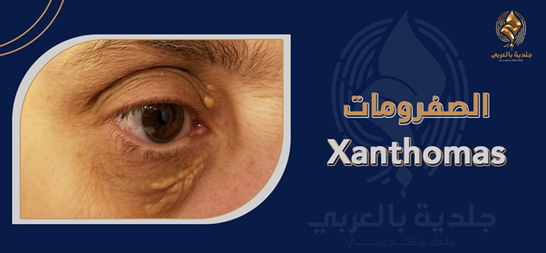 الصفرومات | تعرف إلى داء الأورام الصفر Xanthomas الأعراض والأسباب وطرق العلاج والوقاية