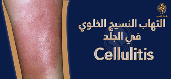 هل التهاب النسيج الخلوي مُعدٍ؟ وكيفية علاج الالتهاب الخلوي؟