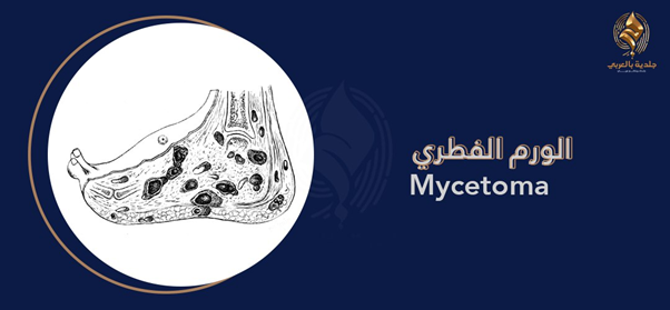 الورم الفطري (Mycetoma) هل له علاج ؟