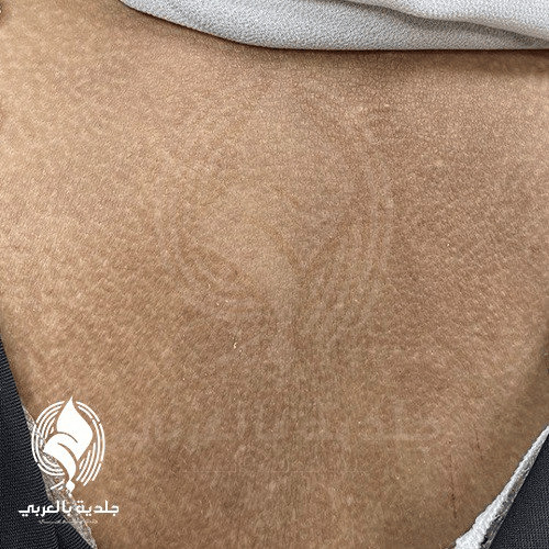 الداء النشواني