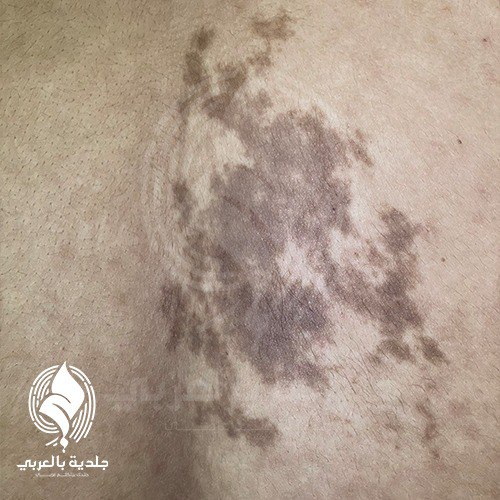 وحمة بيكر