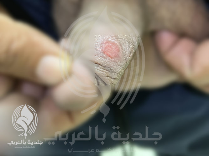 ما هي أهم أعراض القرحة الرخوة؟