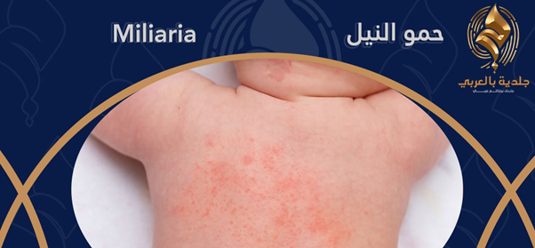 حمو النيل: ما هو؟ وما هو علاج حمو النيل للأطفال وطرق الوقاية منه؟