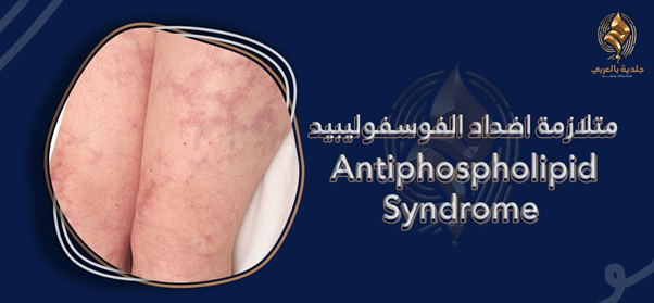 متلازمة اضداد الفوسفوليبيد والحمل | هل هي مرض خطير؟ وما طرق العلاج؟