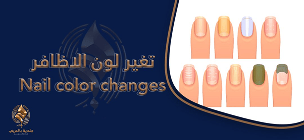 أمراض الأظافر| أسباب تغير لون الاظافر وكيفية علاجه