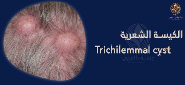 ما الذي يجب معرفته عن الكيسة الشعرية (Pilar cyst)؟