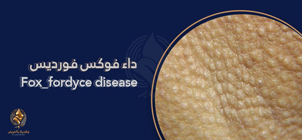 بقع فوردايس (Fordyce Spots) | هل هي مرض خطير؟ وكيف يمكن العلاج منه؟