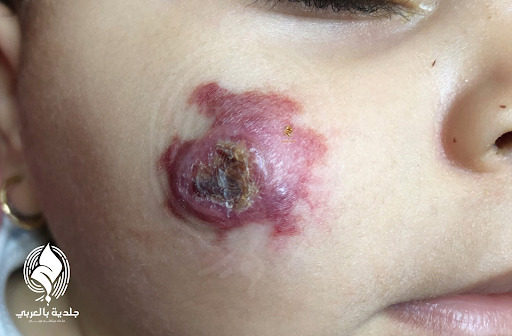 الورم الوعائي الدموي