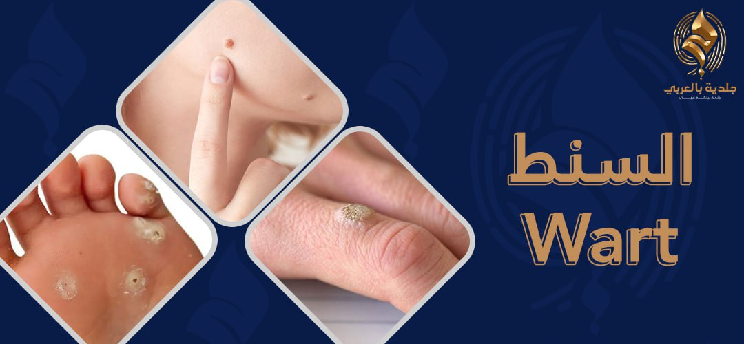 ما أفضل طرق التعامل مع السنط في الجلد؟