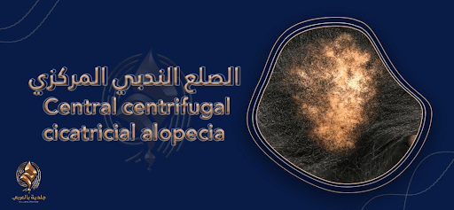 الصلع الندبي المركزي النابذ (central centrifugal cicatricial alopecia) الأسباب والعلاج