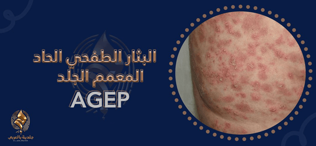 ما خطورة حدوث بثار طفحي حاد معمم AGEP؟
