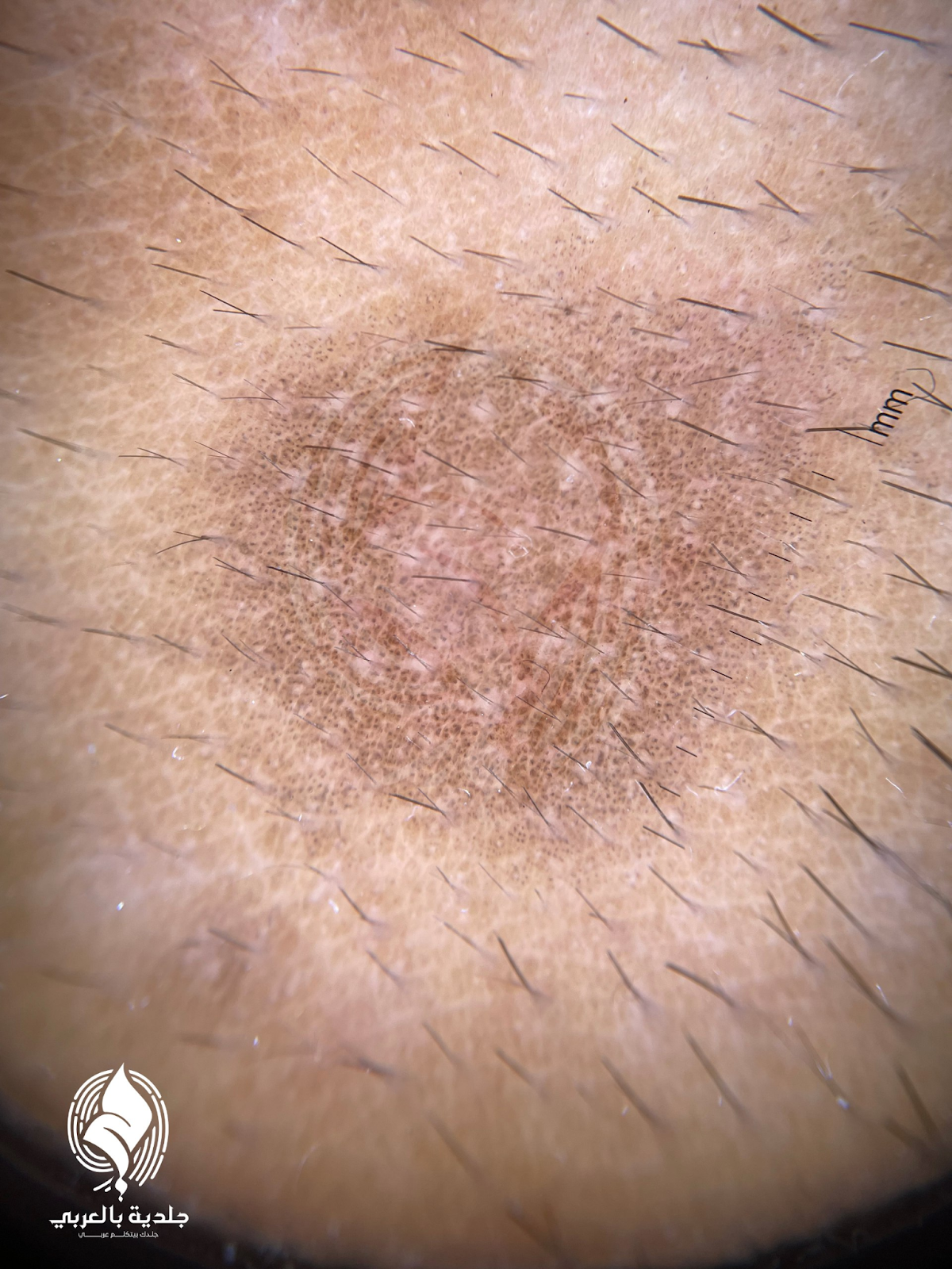 الاكزيما بالصور