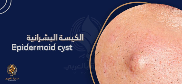 هل يُعد الورم السرطاني سبب من أسباب تكون الكيس البشراني (Epidermoid cyst)؟