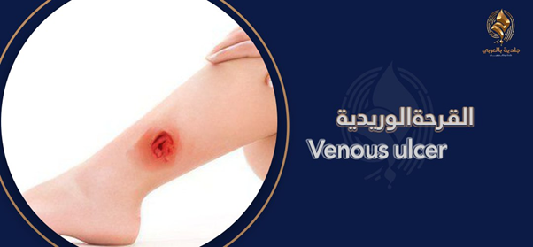 أفضل طرق علاج قرحة القدم الوريدية | دليل شامل لتحسين صحة الساقين