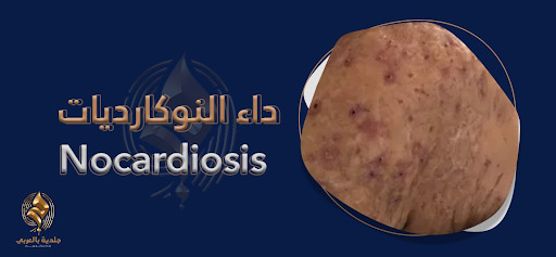 داء النوكارديات (Nocardiosis) | هيا لنتعرف إلى أنواعه وأساليب علاجه