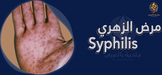 ماهو مرض الزهري؟ تعرف على شكل قرحة الزهري وأعراضه وأسبابه وكيفية علاجه