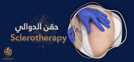بدون جراحة أو ألم: إليك خطوات حقن الدوالي (Sclerotherapy)