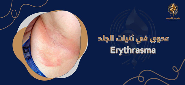 معلومات عن وذح (عدوى في ثنيات الجلد) (Erythrasma) | الأسباب والعلاج