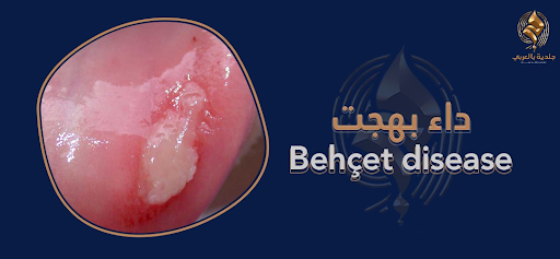 كيف تعرف أنك مصاب بداء بهجت؟…قصة مرض مناعي نادر