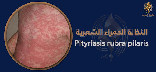 ما مرض النخالة الحمراء الشعرية؟ وما أسبابه وأساليب علاجه؟
