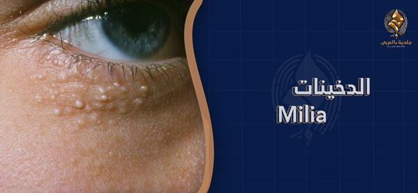 الدخينات (حبوب الميليا)| أسباب ظهور حبوب الميليا وأنواعها وطرق العلاج
