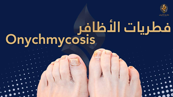 فطريات أظافر اليد والقدم: الأسباب والأعراض وطُرق العلاج