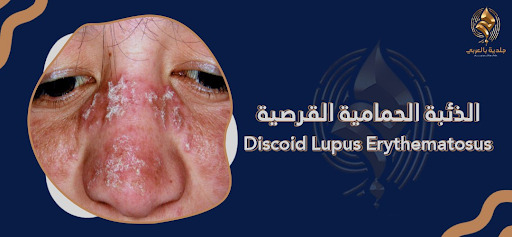 هل يستدعي مرض الذئبة الحمامية القرصية القلق؟