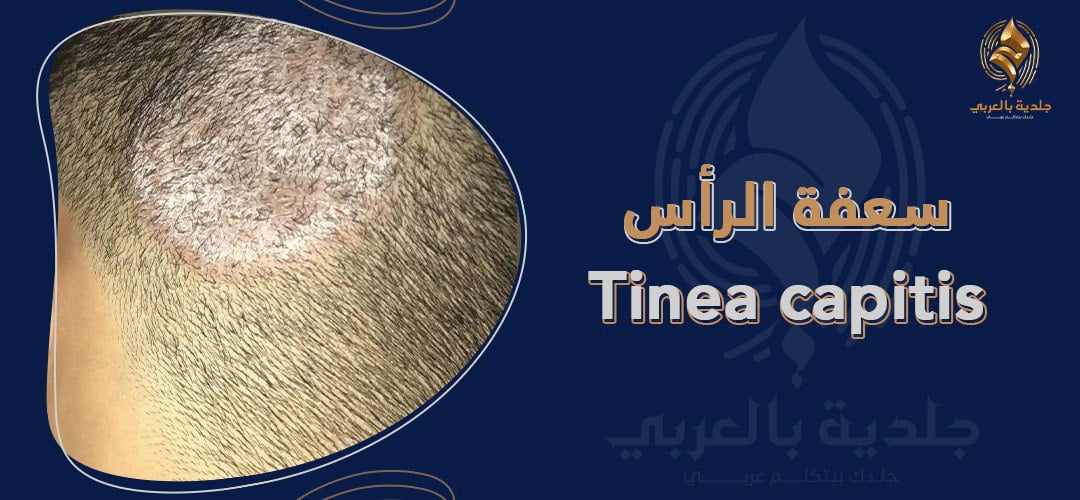 ما علاج سعفة الراس؟ وما أسبابها؟