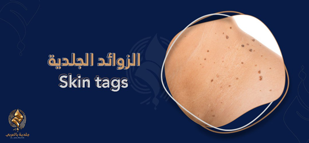 تعرف على أشكال الزوائد الجلدية بالصور | هل هي أورام سرطانية؟