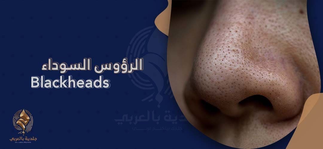 تعرف على أسباب ظهور الرؤوس السوداء وطرق تنظيف الرؤوس السوداء بالبيت وعلاجها