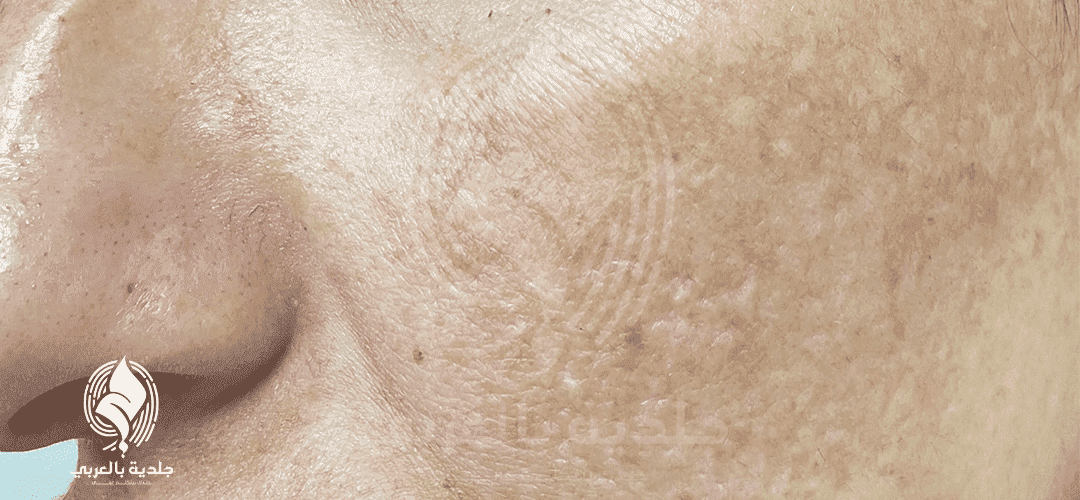 اعراض الكلف