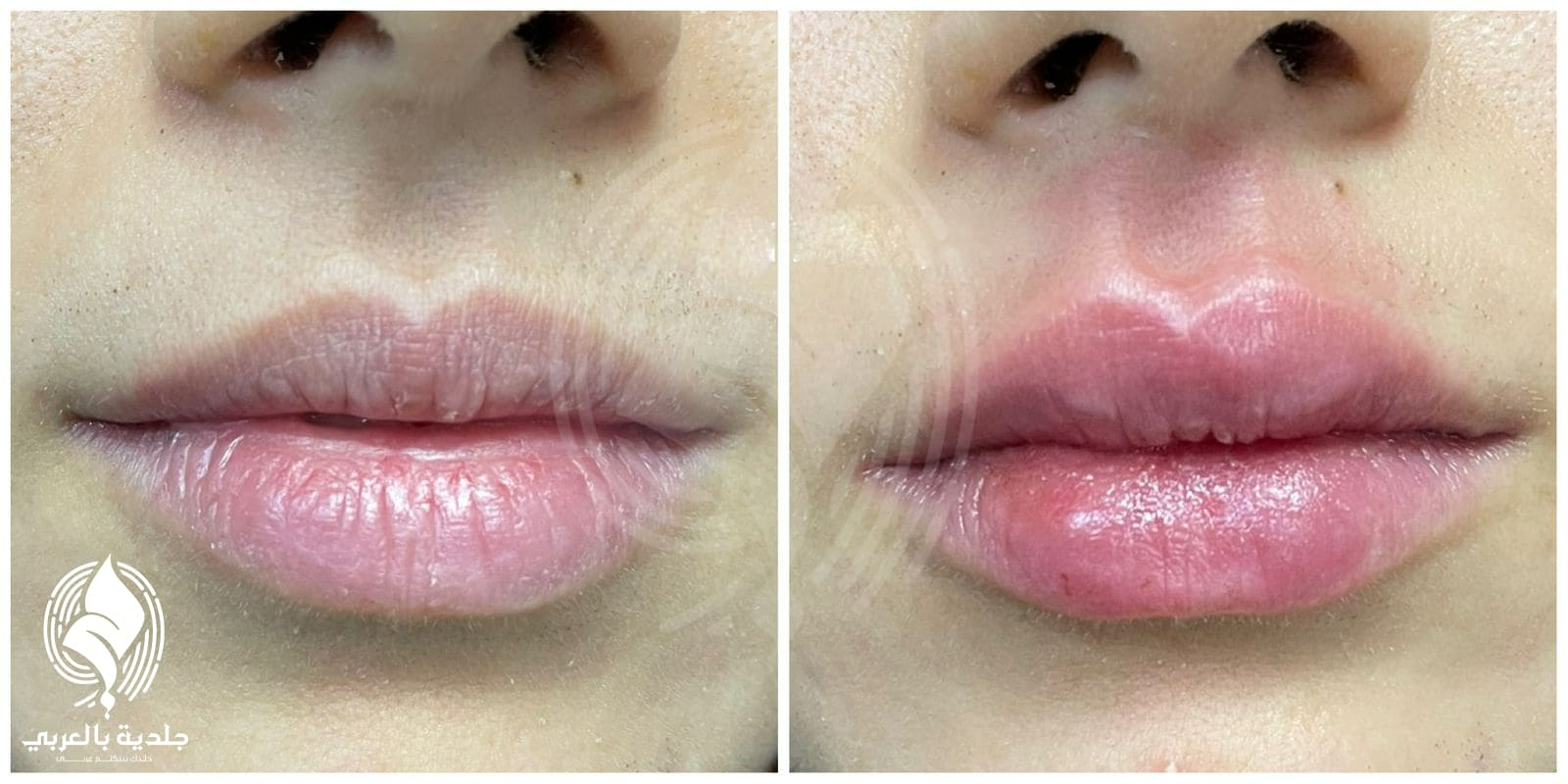 اضرار الفيلر للشفايف